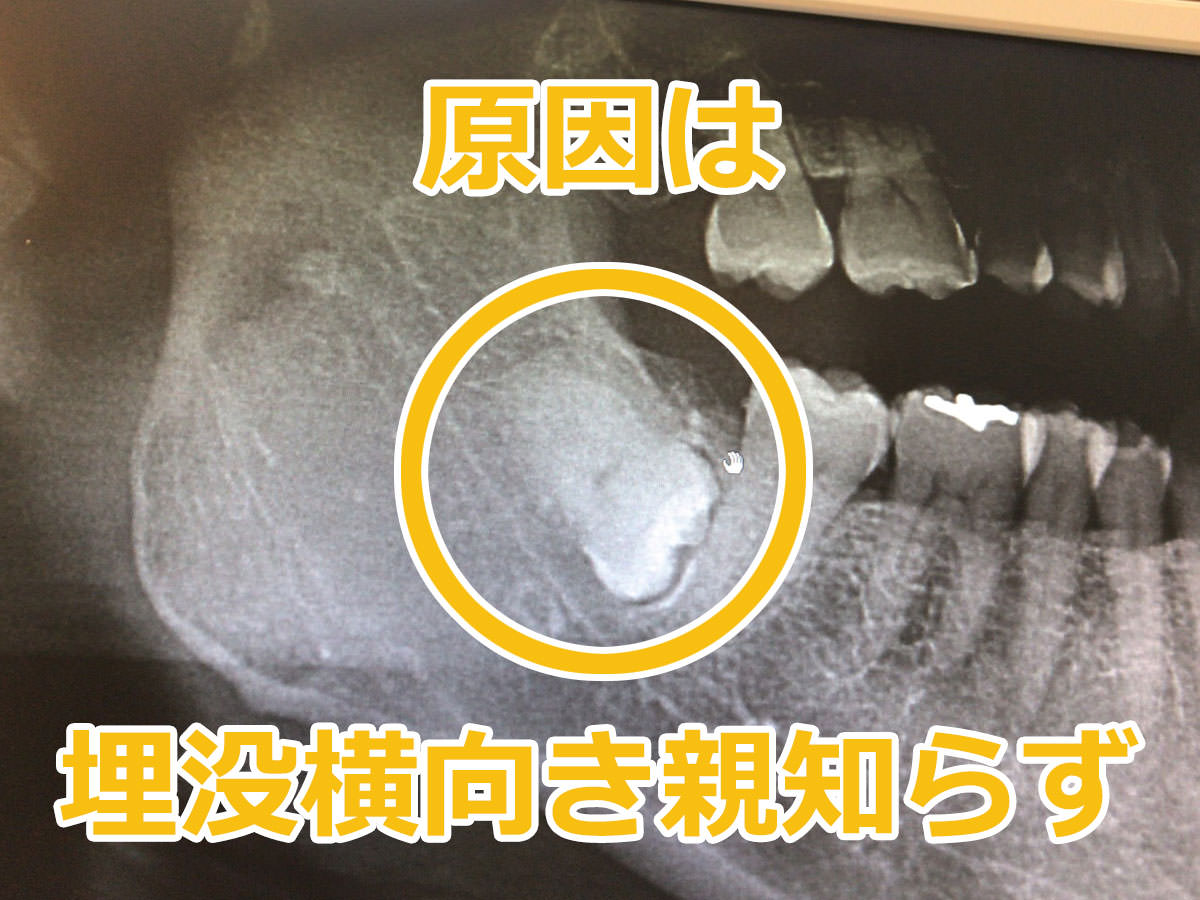 写真：歯のレントゲン 親知らず